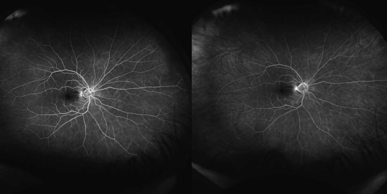 Cotton-wool spots - American Academy of Ophthalmology